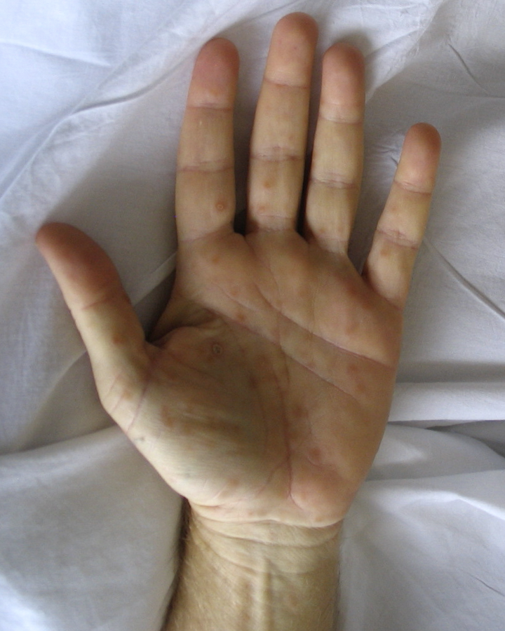 ซิฟิลิส Syphilis คืออะไร